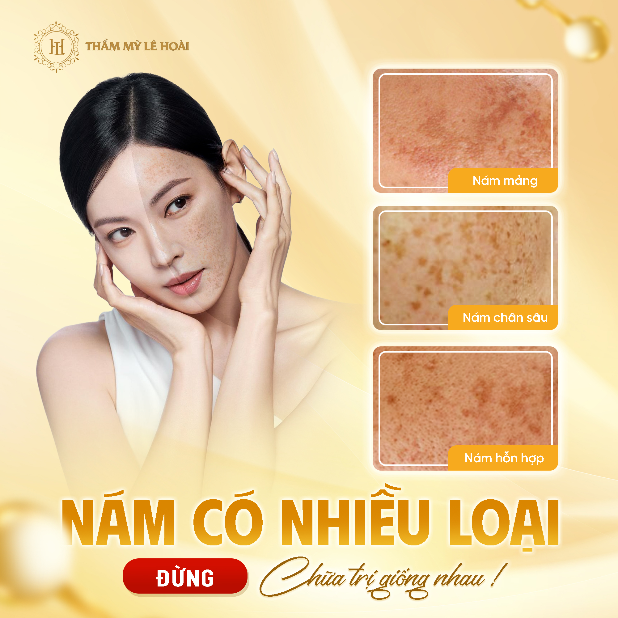 Phân biệt các loại nám da và cách nhận biết