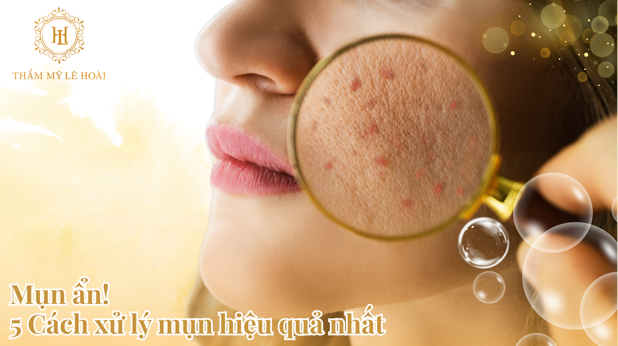 5 Cách xử lý mun hiệu quả