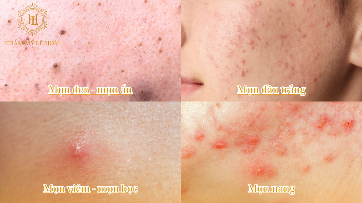 Phân biệt các loại mụn thường gặp và cách xử lý mụn phù hợp 4 Phân biệt các loại mụn thường gặp và cách xử lý phù hợp