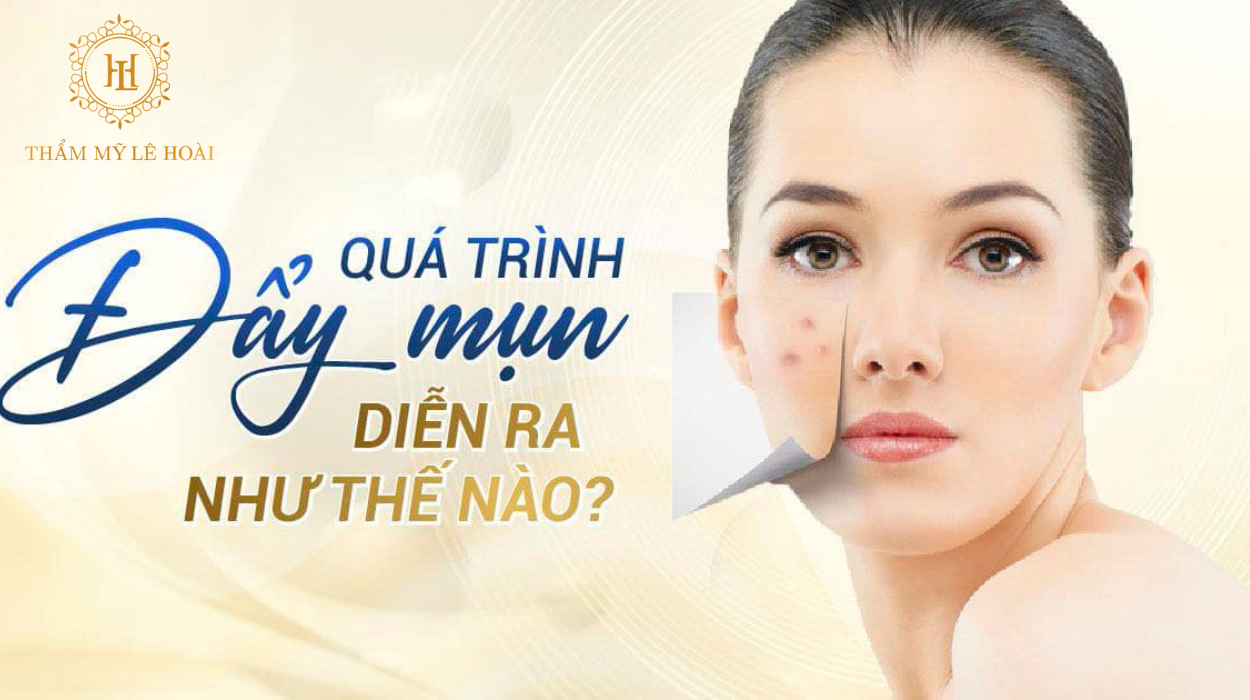 Phương pháp xử lý mụn tại Thẩm mỹ viện Lê Hoài