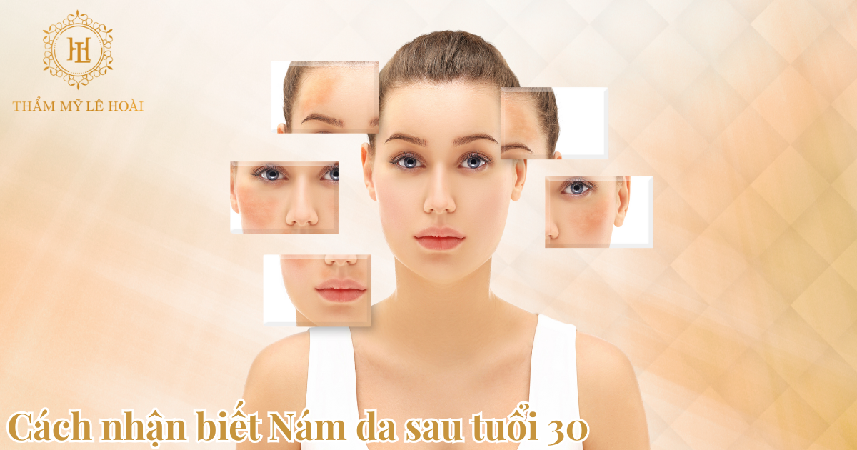 Cách nhận biết Nám da sau tuổi 30