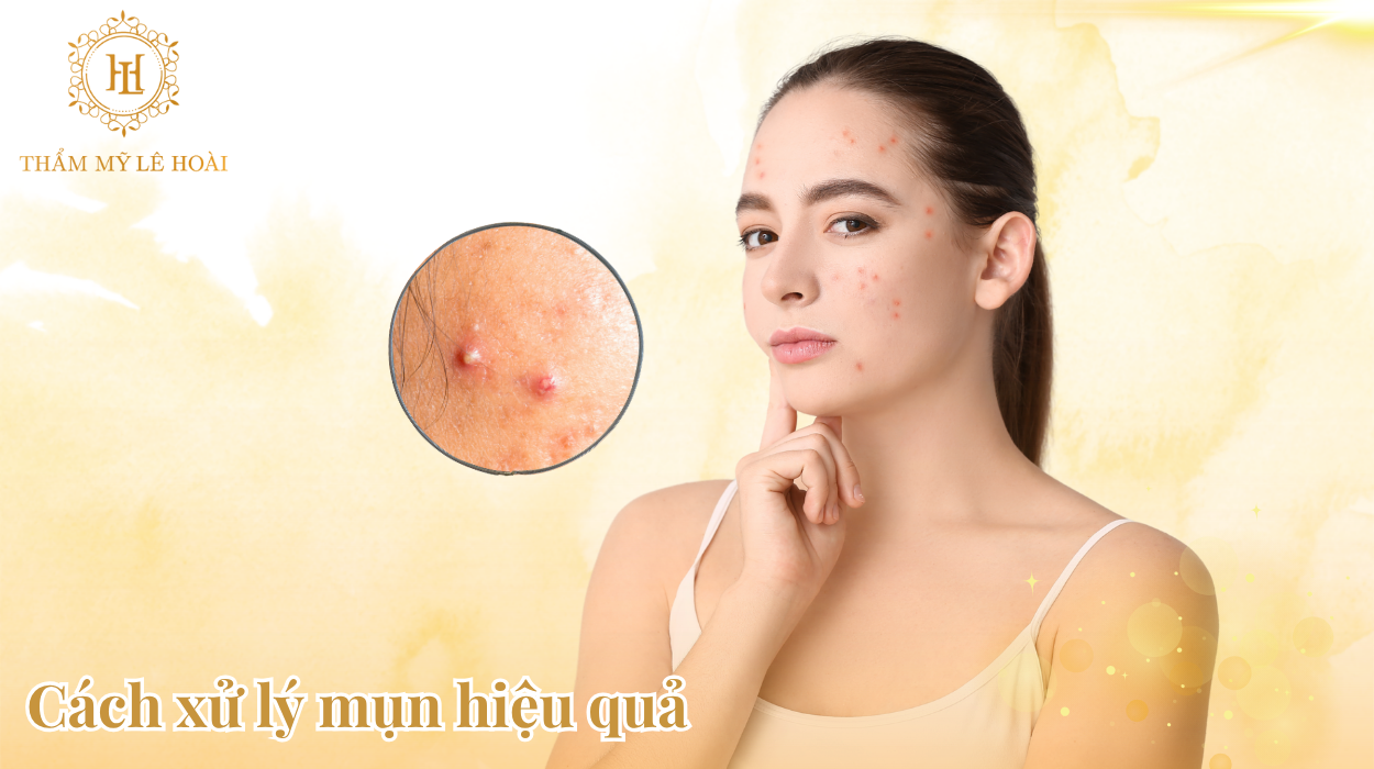 Cách xử lý mụn hiệu quả | Thẩm mỹ viện Lê Hoài