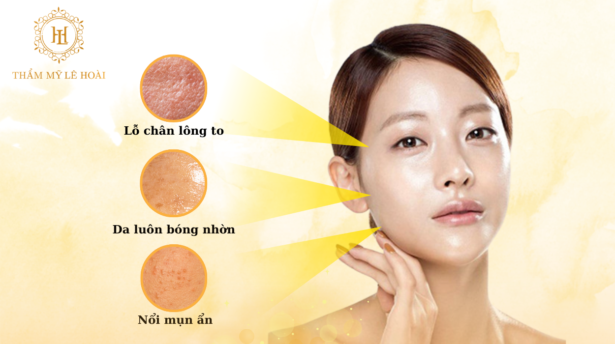 Da dầu có nên xử lý mụn theo cách thông thường? 6 Đặc điểm của da dầu