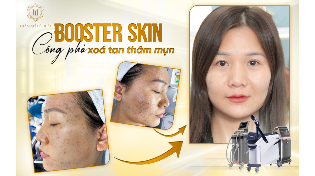 Mụn Ẩn là gì? 5 Cách xử lý mụn ẩn triệt để không tái phát 7 Liệu trình xử lý mụn chuyên sâu tại Thẩm mỹ viện Lê Hoài