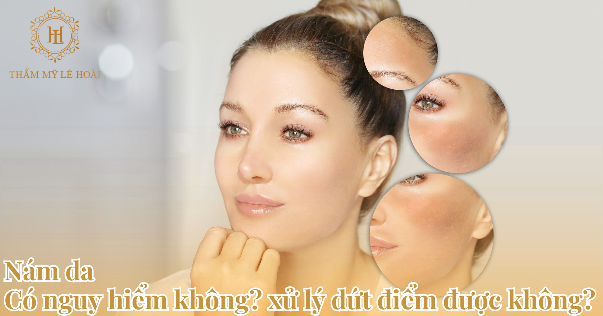 Nám da có xử ly dứt điểm được không?