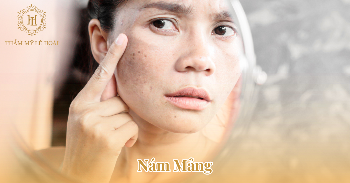 Phân Biệt Các Loại Nám Da và Cách Nhận Biết Chính Xác Nhất 5 Nám mảng | Thẩm Mỹ Viện Lê Hoài