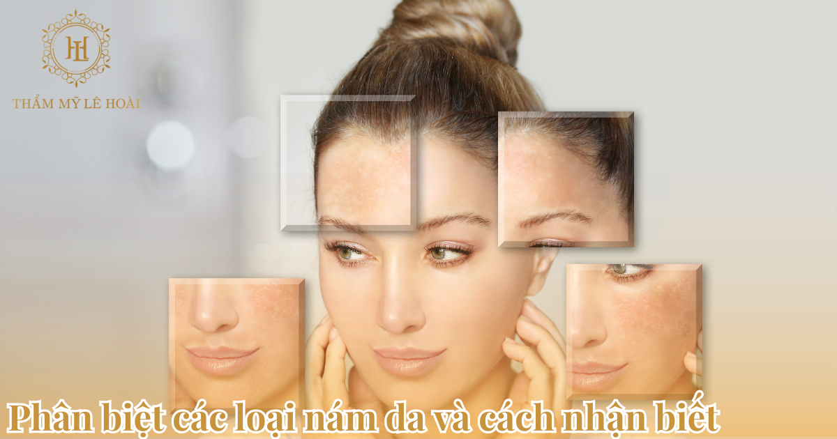 Phân Biệt Các Loại Nám Da và Cách Nhận Biết Chính Xác Nhất 4 Phân biệt các loại nám da và cách nhận biết