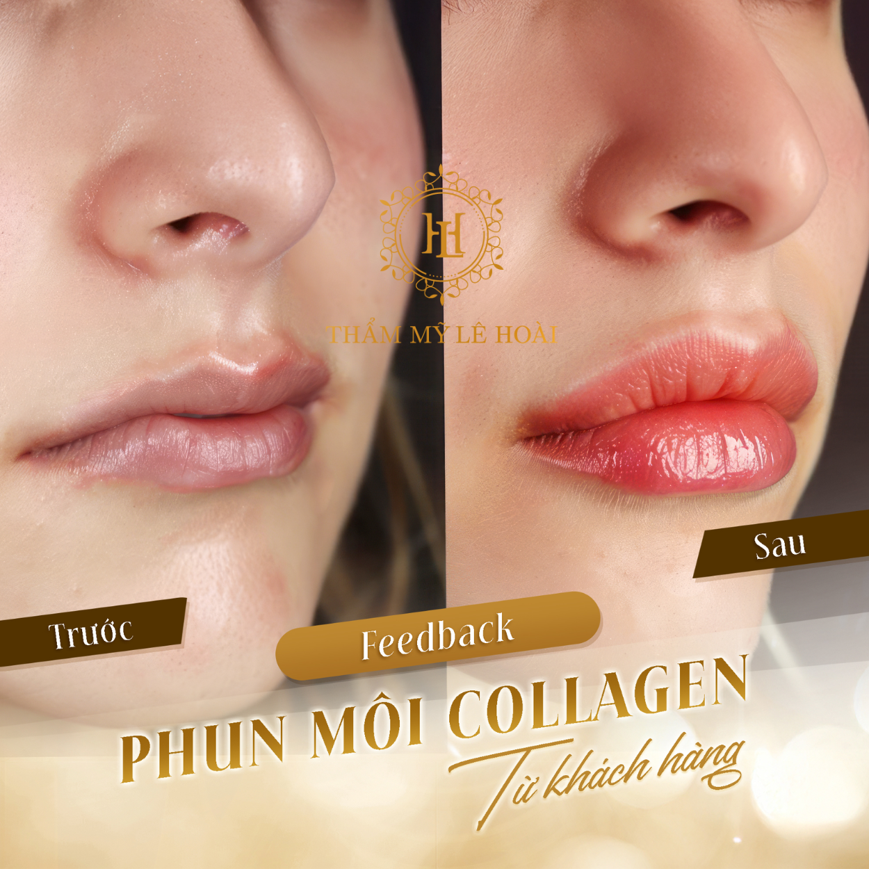 Phun môi Collagen thẩm mỹ tại TMV Lê Hoài