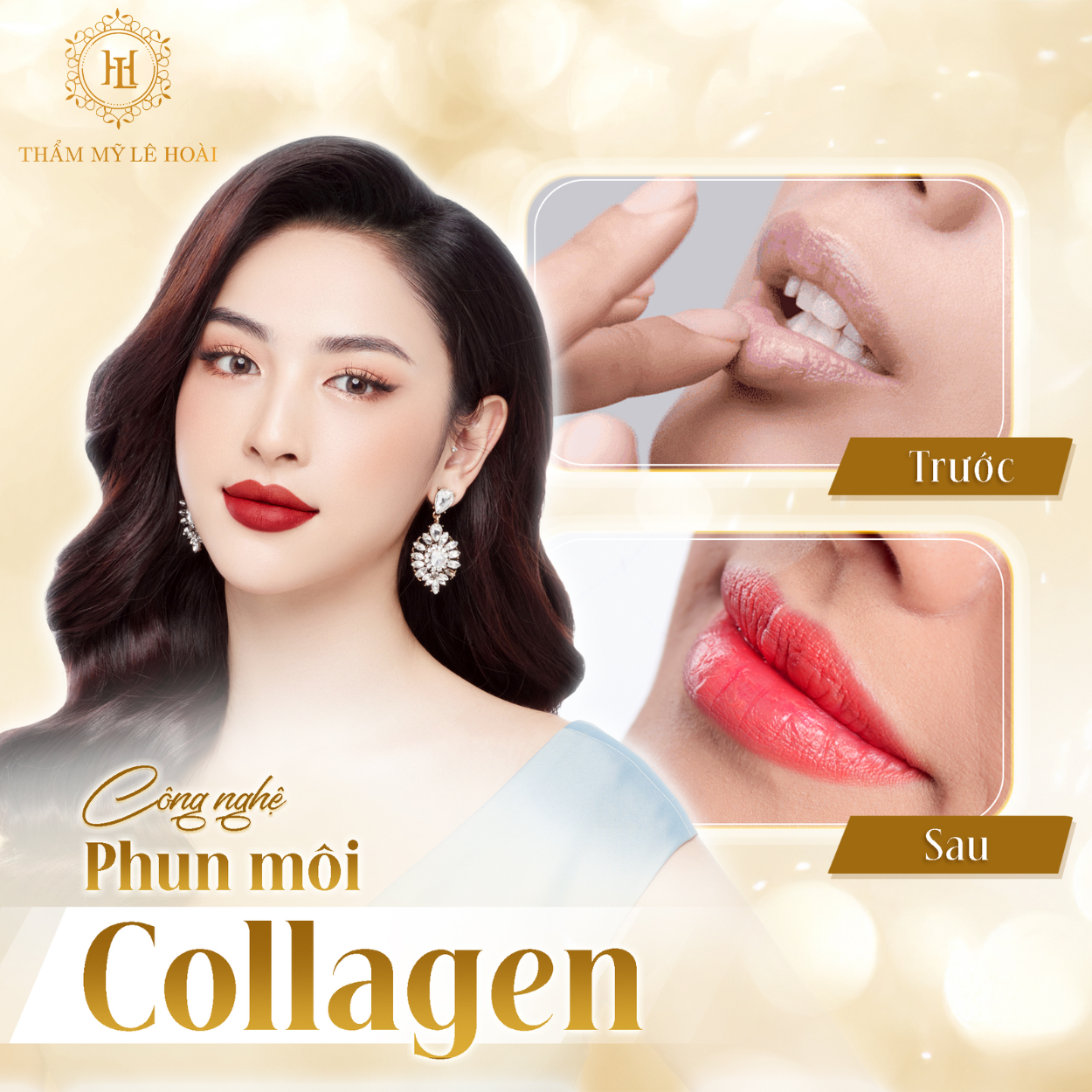 Phun môi Collagen thẩm mỹ tại TMV Lê Hoài