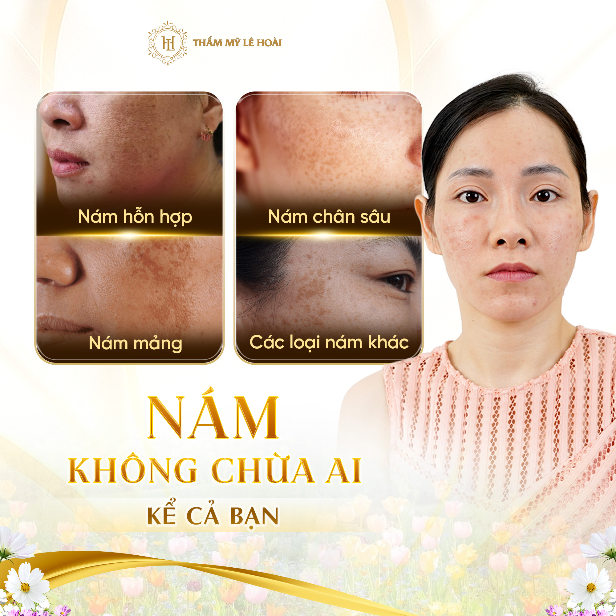 Xử lý nám da chuyên sâu | Thẩm mỹ Lê Hoài