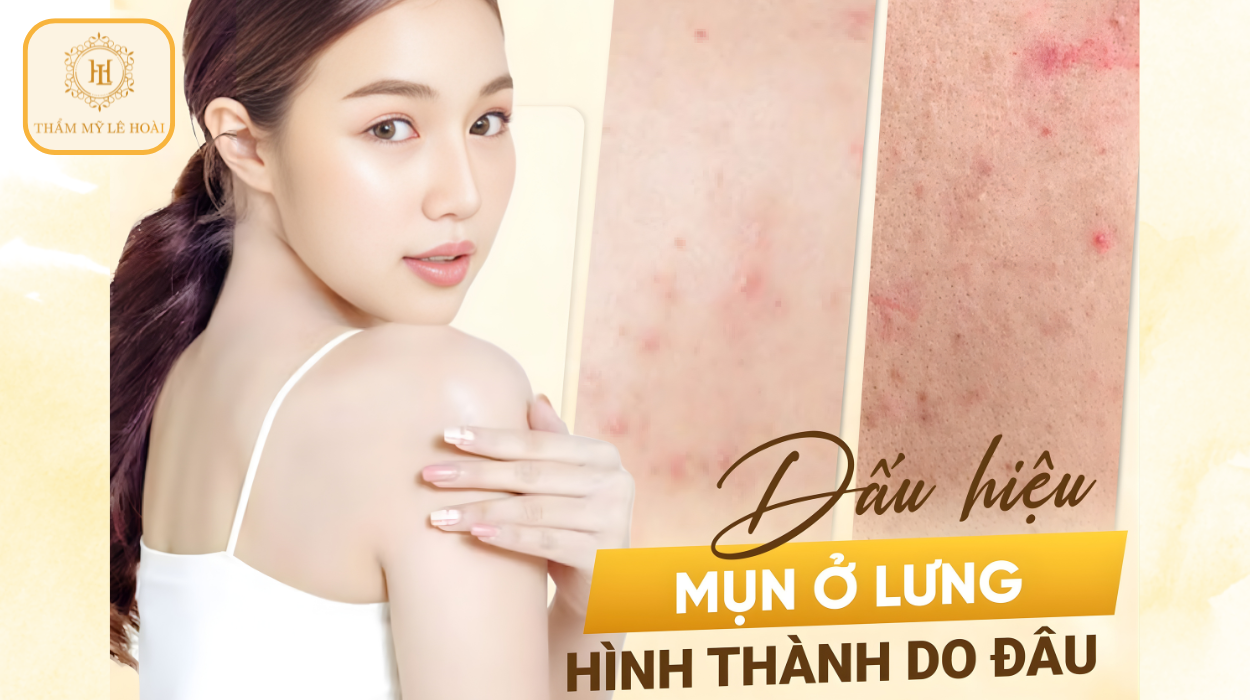 Trị mụn lưng dứt điểm cần bao nhiêu buổi | Thẩm mỹ Lê Hoài